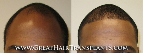 hair transplants cost