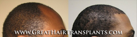 hair transplant surgery