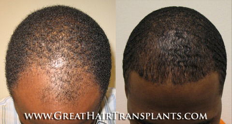 hair transplants cost