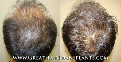 hair transplant cost