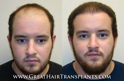 hair transplants cost