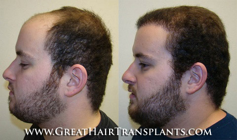 low cost hair transplants