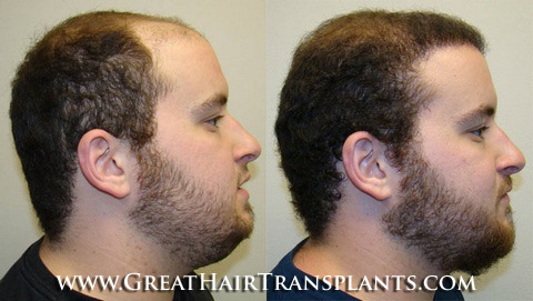 Female Hair Loss Treatment & Restoration in Texas Austin Beard