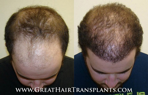 hair loss prevention