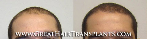 affordable hair transplants