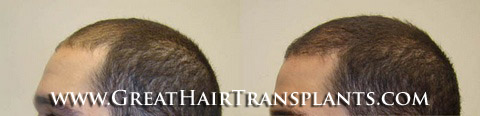 affordable hair transplants