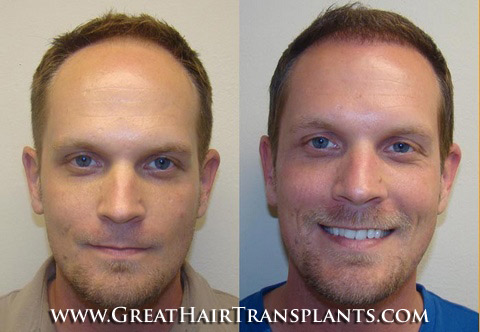 affordable hair transplants