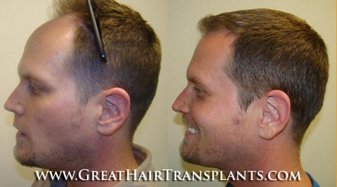 low cost hair transplants