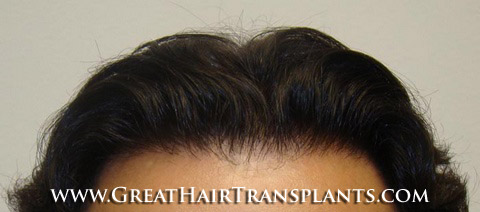 hair transplant