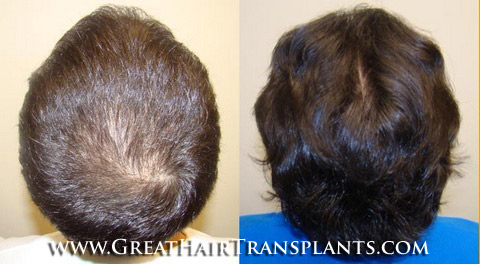 hair transplant cost