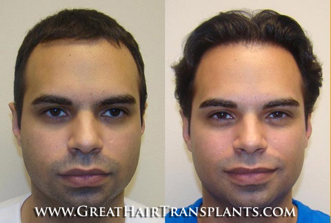 hair restoration