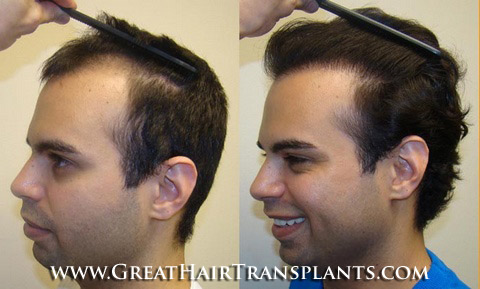 hair transplant surgery