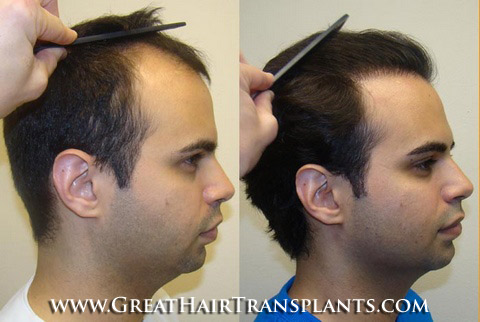 hair transplants