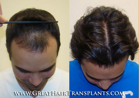 hair transplant cost