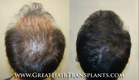 hair transplants cost