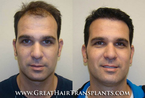 low cost hair transplant