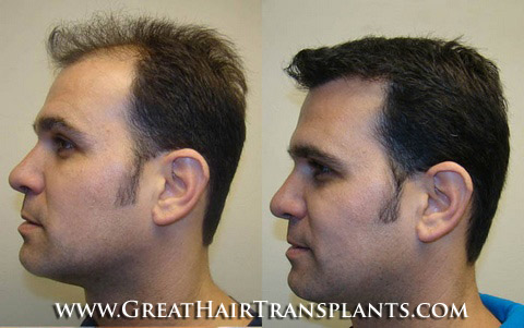 hair transplant cost