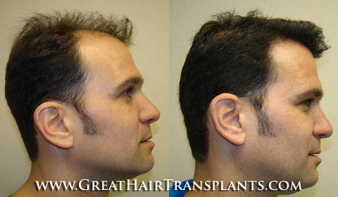 affordable hair transplants