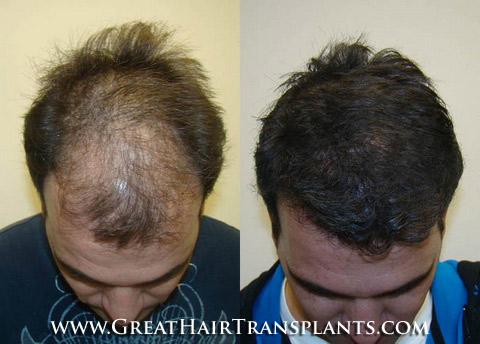 hair transplants