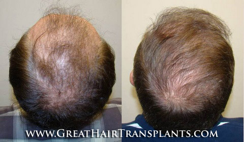 hair transplant