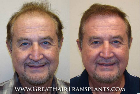 hair transplants cost