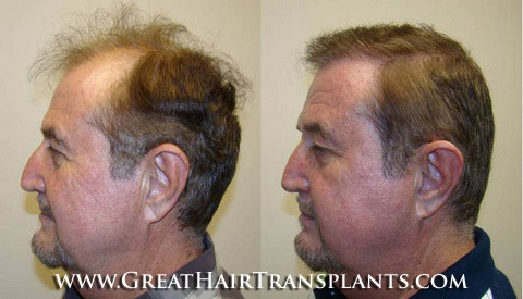 hair transplants cost