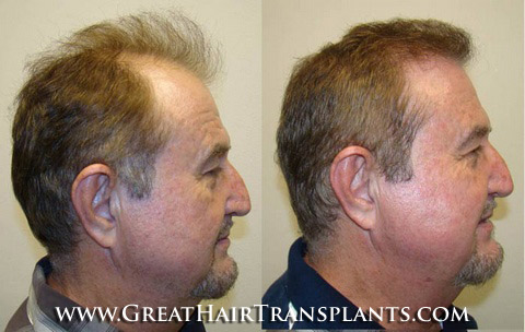 hair transplants cost