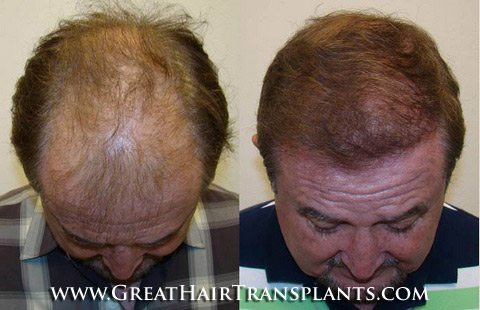 hair transplants cost