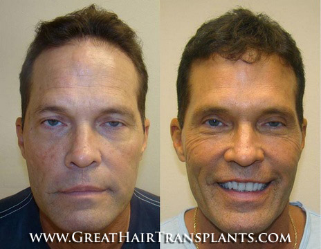 hair transplant surgery