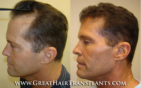 hair transplant cost