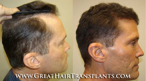 hair restoration