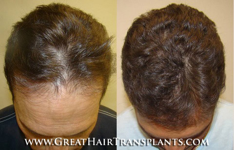 hair transplant