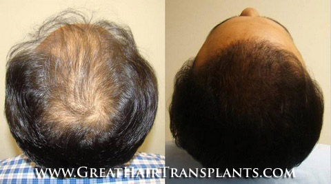 hair transplant surgery