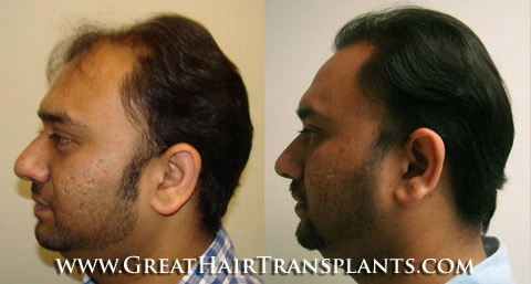 hair transplants cost