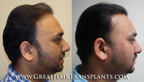 hair transplant cost