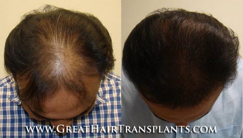 hair transplant surgery