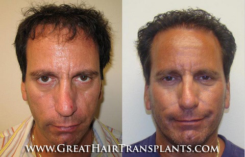 hair transplant cost