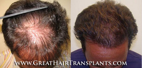 hair transplant