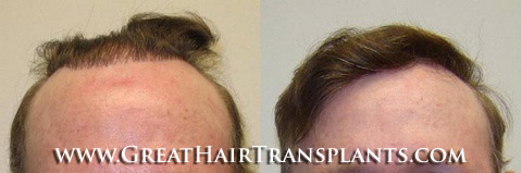 low cost hair transplants