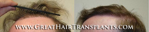 hair transplants cost