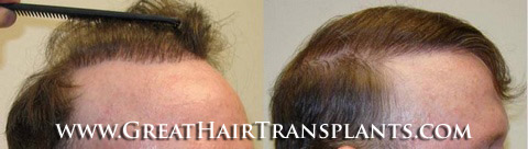 low cost hair transplant