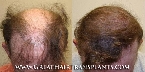 affordable hair transplants