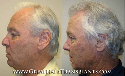 hair transplants cost