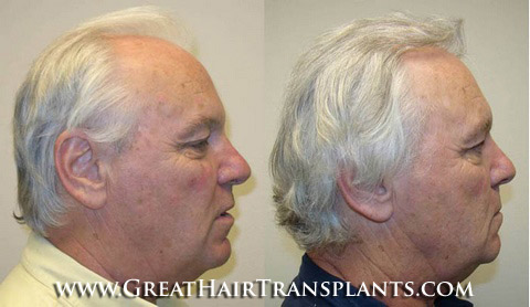 hair transplants cost