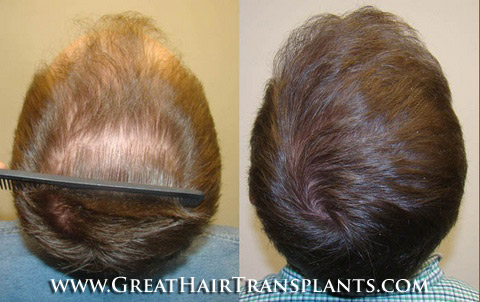 affordable hair transplants