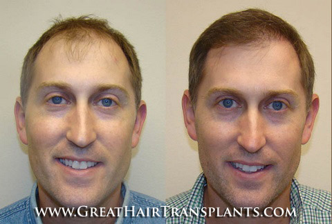 hair restoration