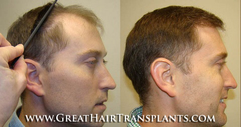 affordable hair transplants