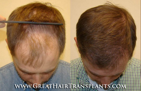 hair transplant cost