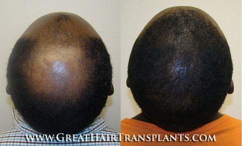 hair restoration