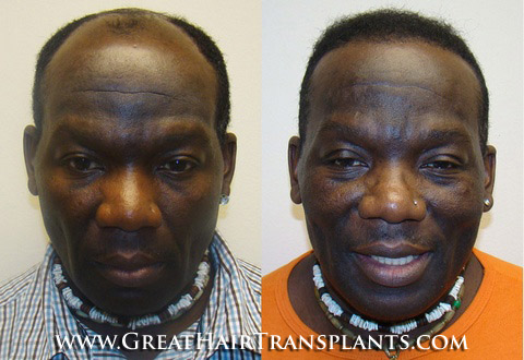 hair transplant cost